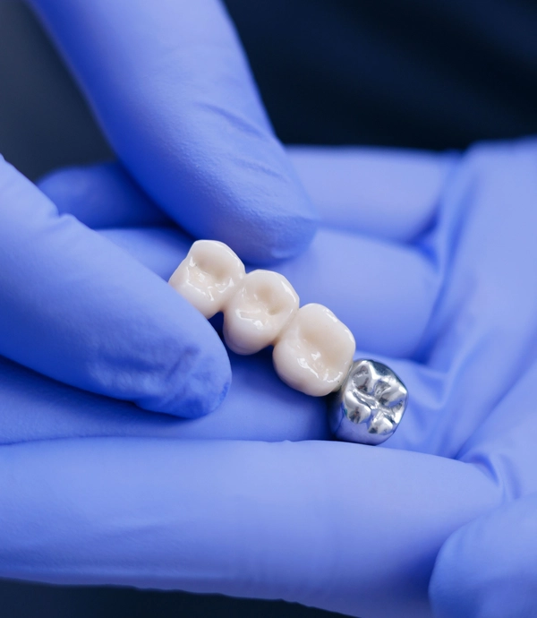 Dental Bridges at [practice_name]