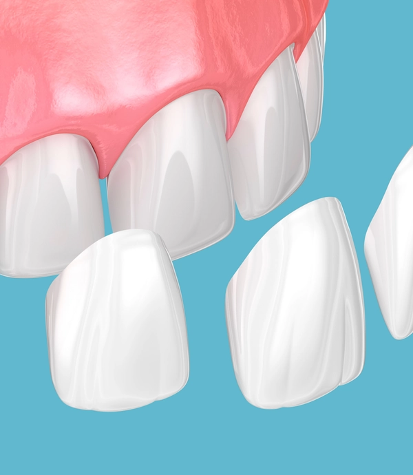 Dental Veneers at [practice_name]