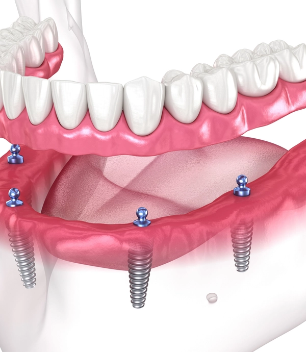 Implant Supported Dentures at [practice_name]